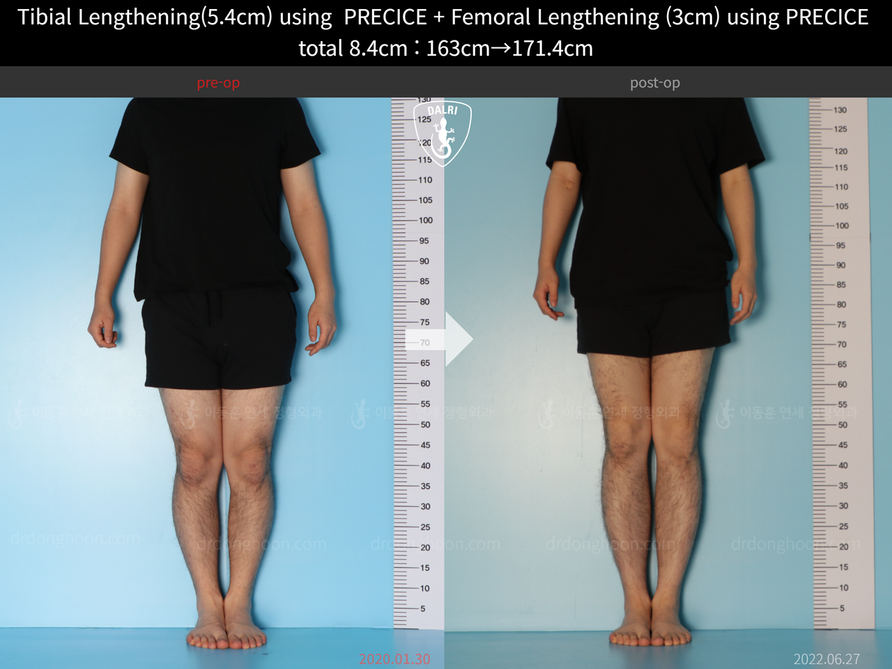 Before and after cll precice, case 12051302, image 3, Dr. Donghoon institute (DALRI)