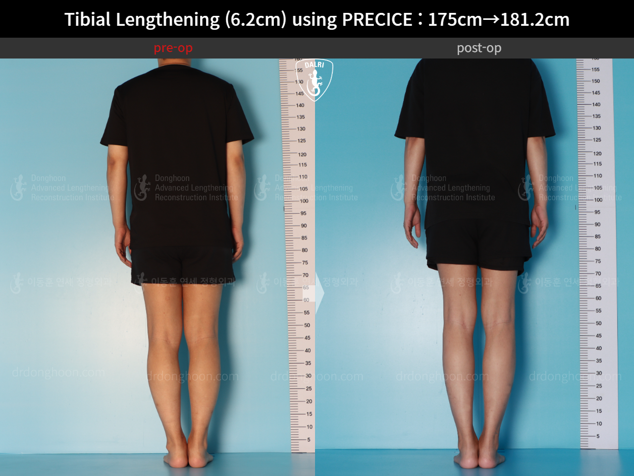 Before and after cll precice, case 16277428, image 3, Dr. Donghoon institute (DALRI)