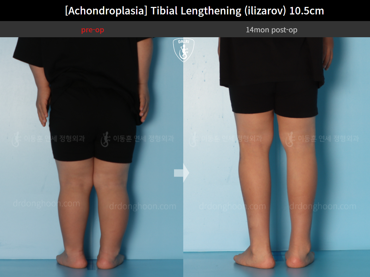 Before and after paediatric congenital condition, case 15707315, image 3, Dr. Donghoon institute (DALRI)