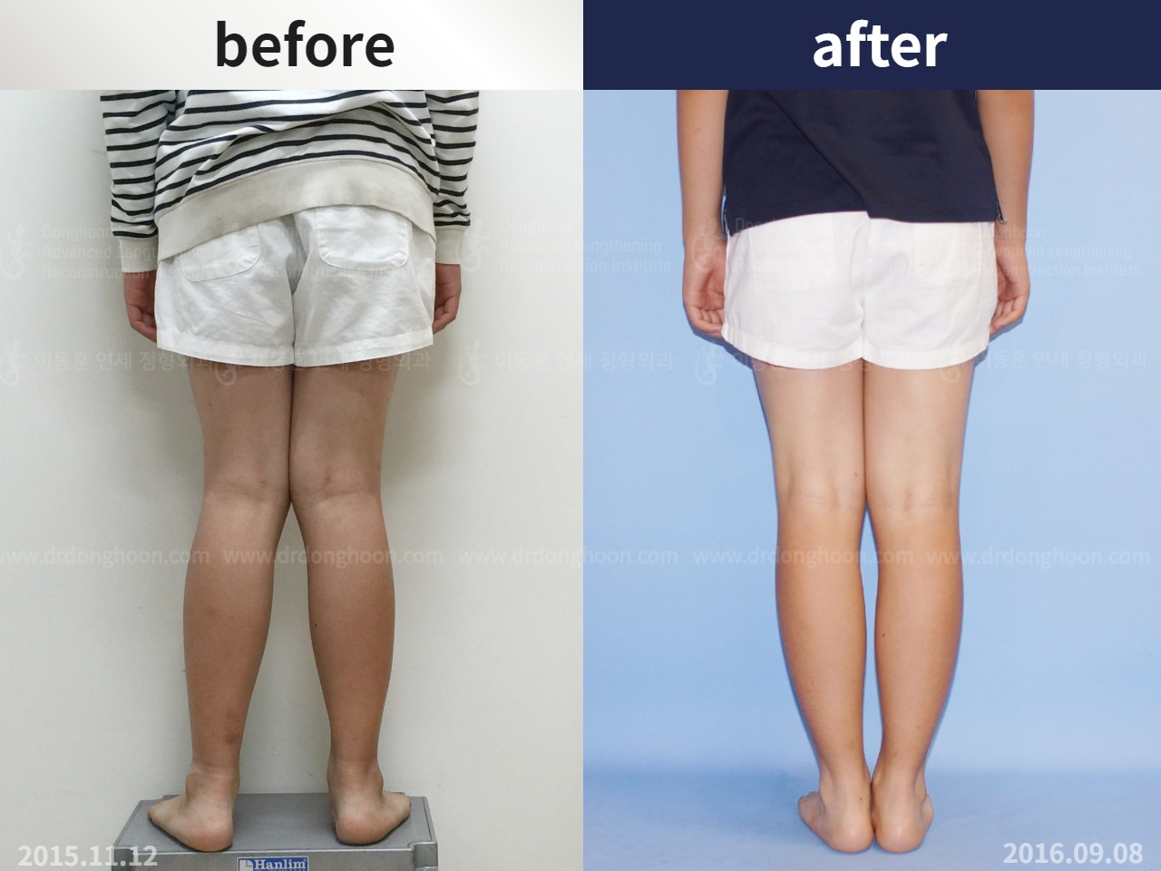 Before and after paediatric & adolescent knock knees, case 4586257, image 2, Dr. Donghoon institute (DALRI)