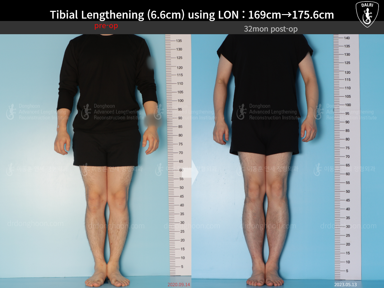 Before and after cll lon, case 15166302, image 5, Dr. Donghoon institute (DALRI)