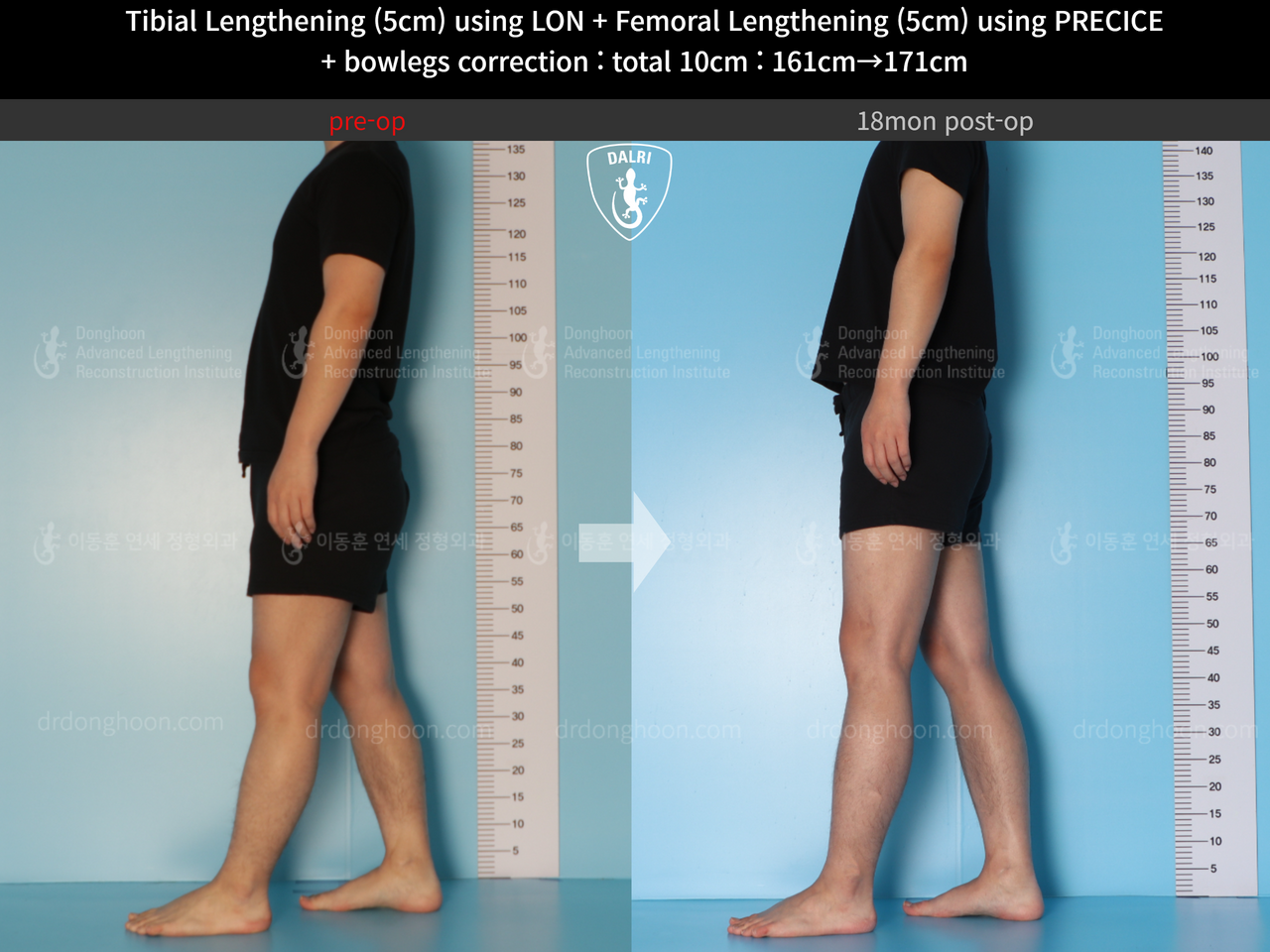 Before and after cll precice, case 13660867, image 5, Dr. Donghoon institute (DALRI)