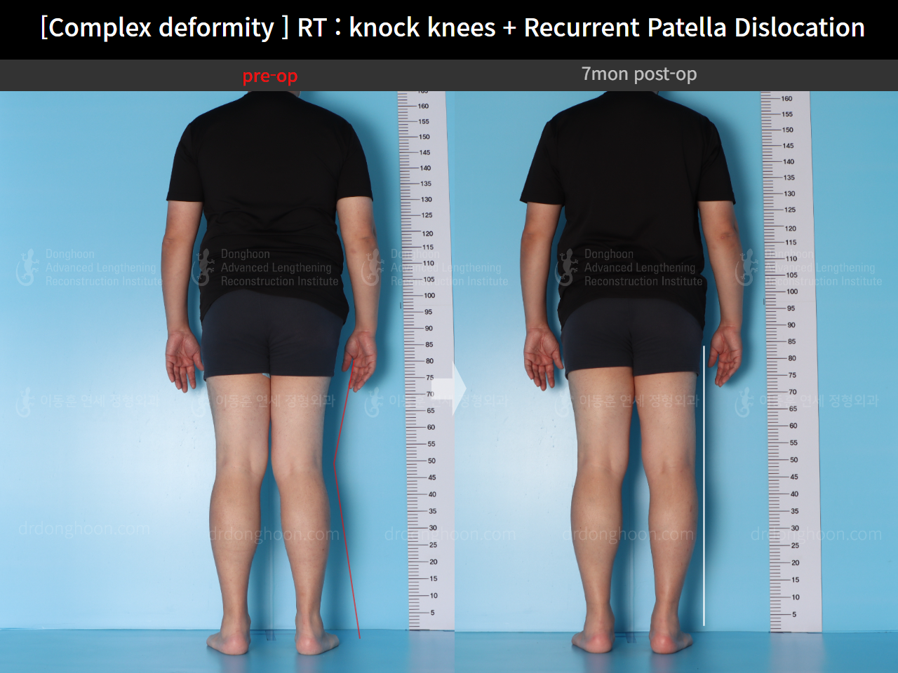 Before and after recurrent patella dislocation, case 16147031, image 3, Dr. Donghoon institute (DALRI)