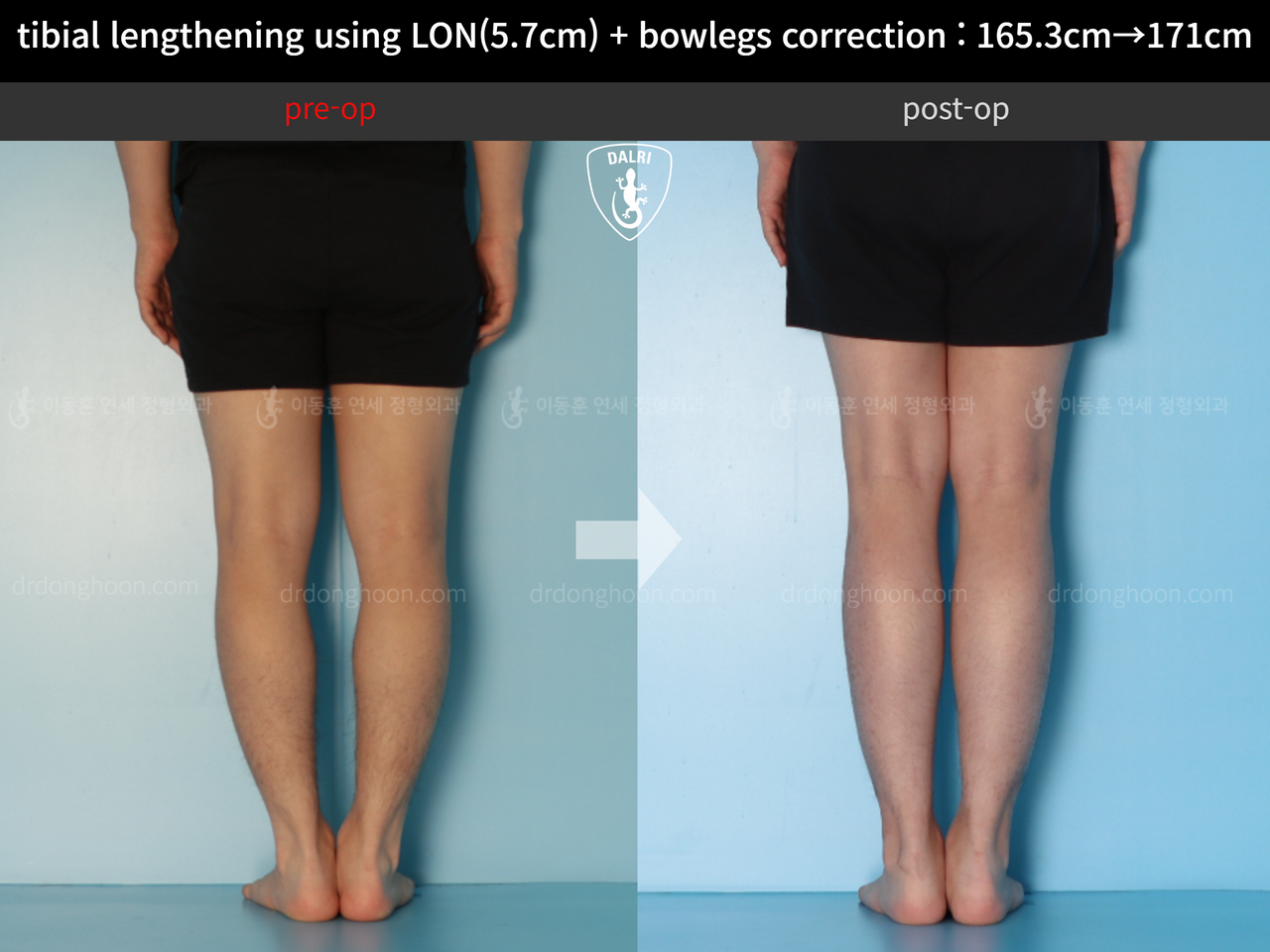 Before and after cll + deformity correction, case 12679153, image 6, Dr. Donghoon institute (DALRI)