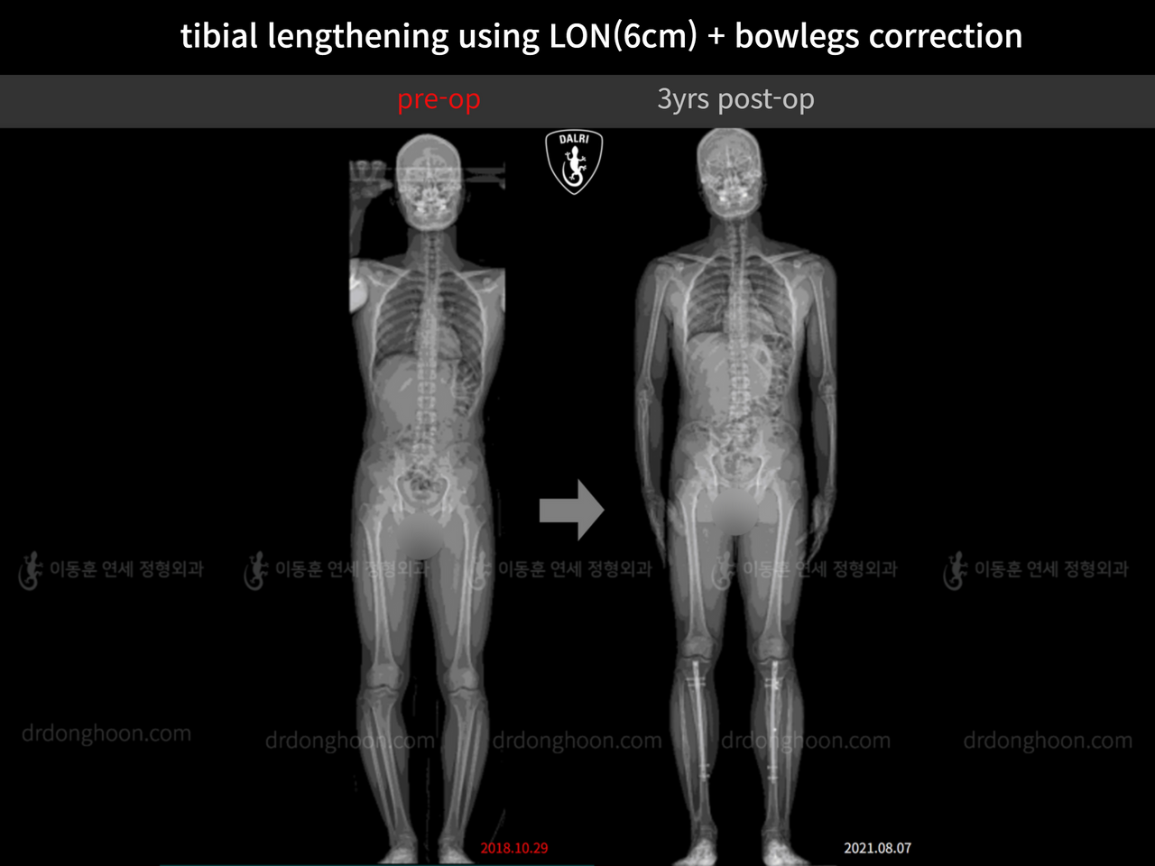 Before and after cll + deformity correction, case 12189565, image 1, Dr. Donghoon institute (DALRI)