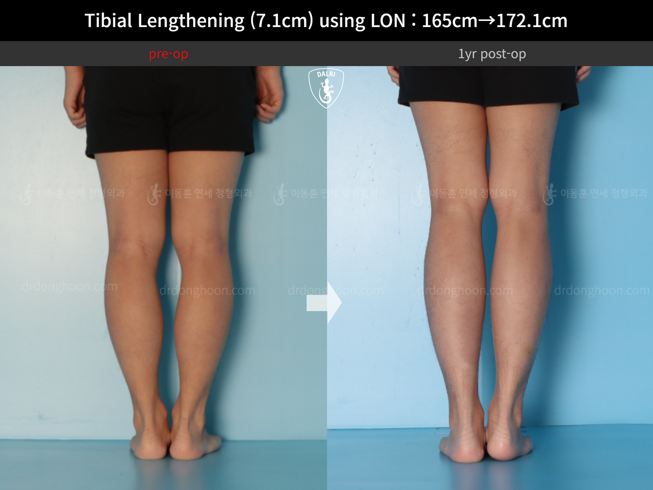 Before and after cll lon, case 14318674, image 8, Dr. Donghoon institute (DALRI)