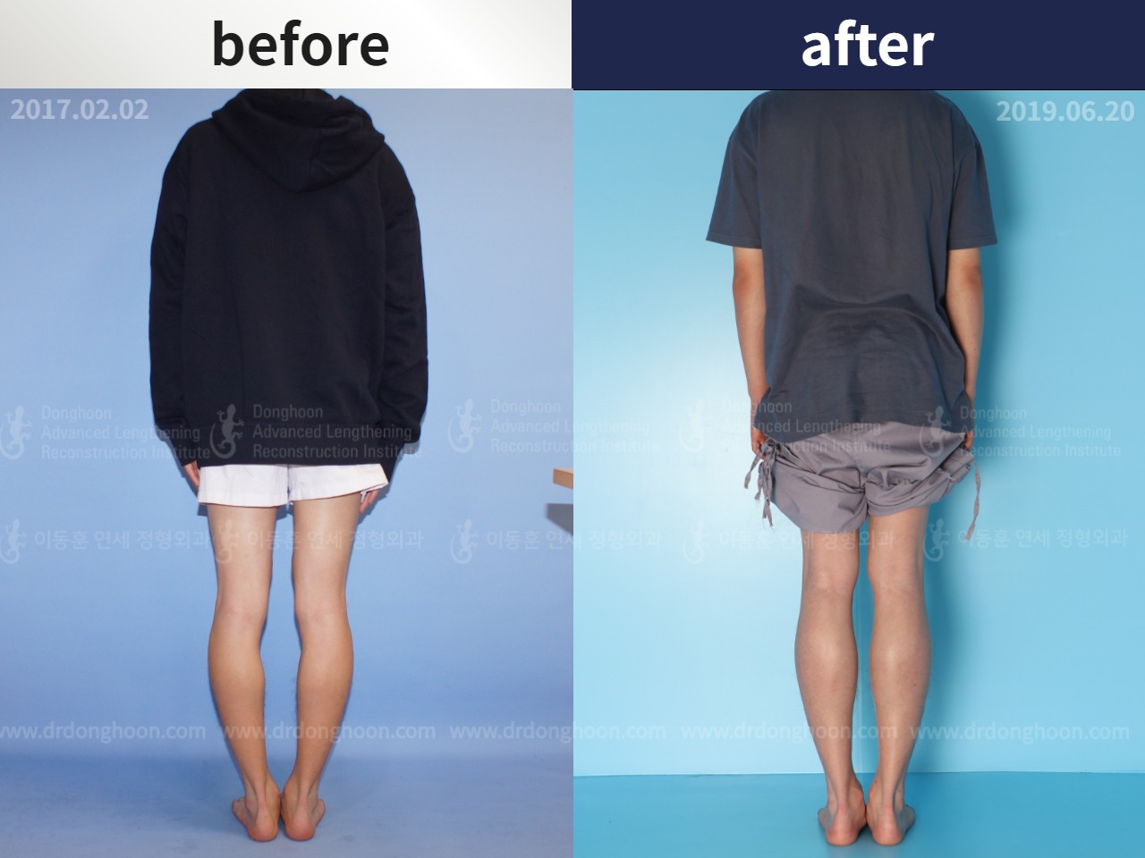 Before and after cll + deformity correction, case 4585657, image 2, Dr. Donghoon institute (DALRI)