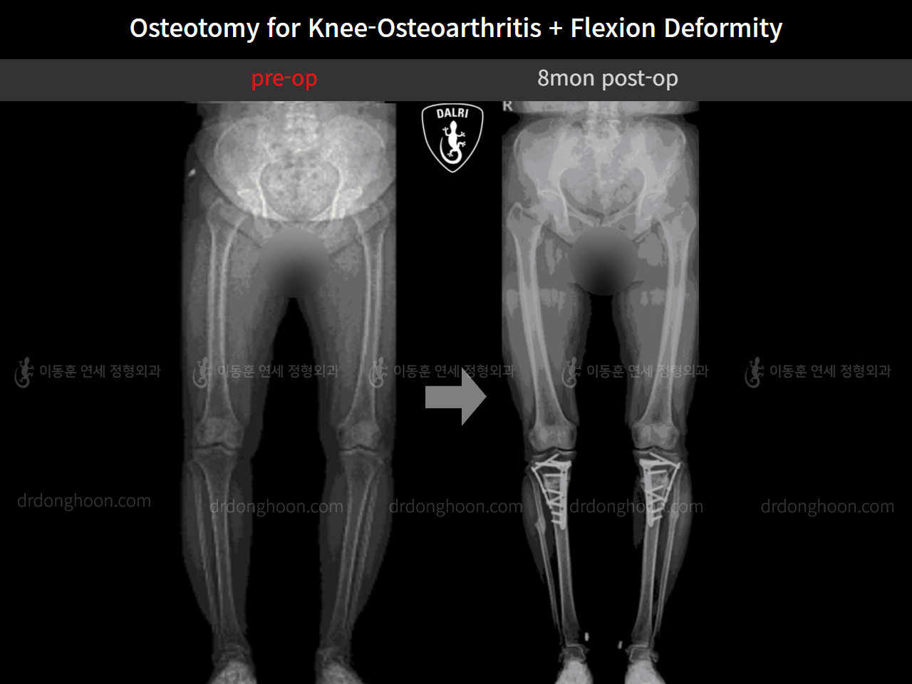 Before and after osteotomy for knee osteoarthritis, case 10663581, image 7, Dr. Donghoon institute (DALRI)
