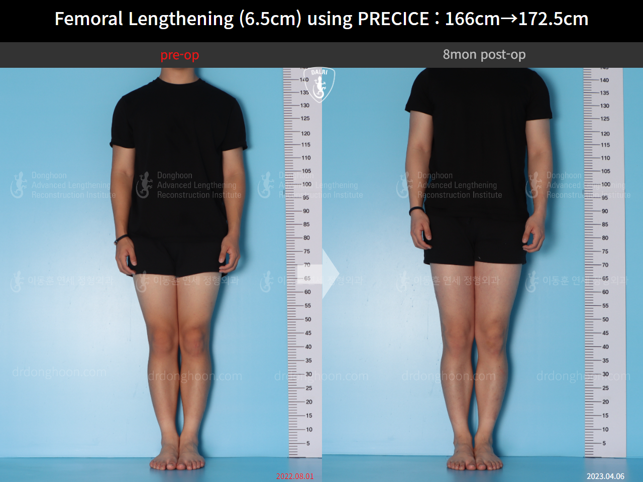 Before and after cll precice, case 14706614, image 1, Dr. Donghoon institute (DALRI)
