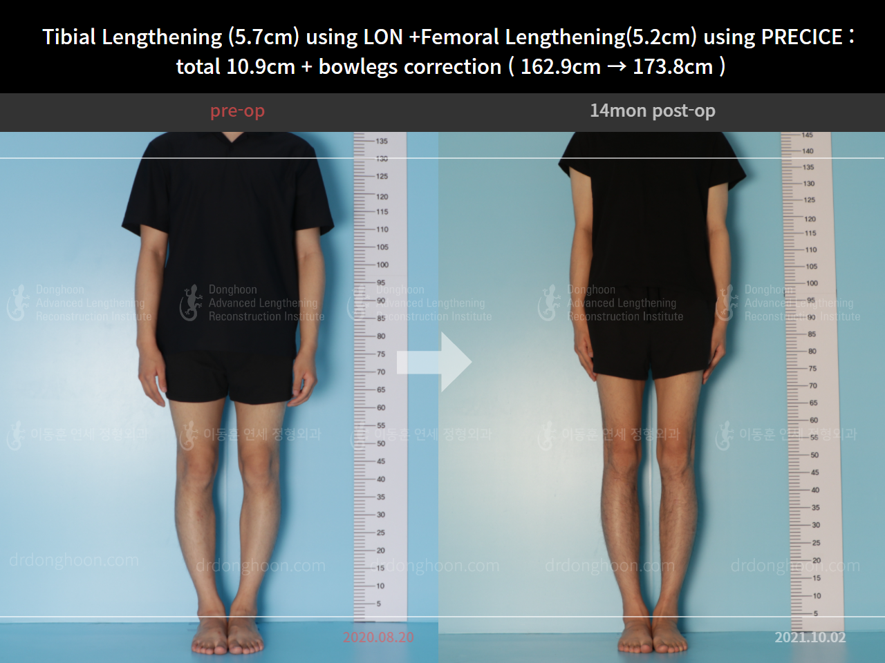 Before and after cll precice, case 8417903, image 1, Dr. Donghoon institute (DALRI)