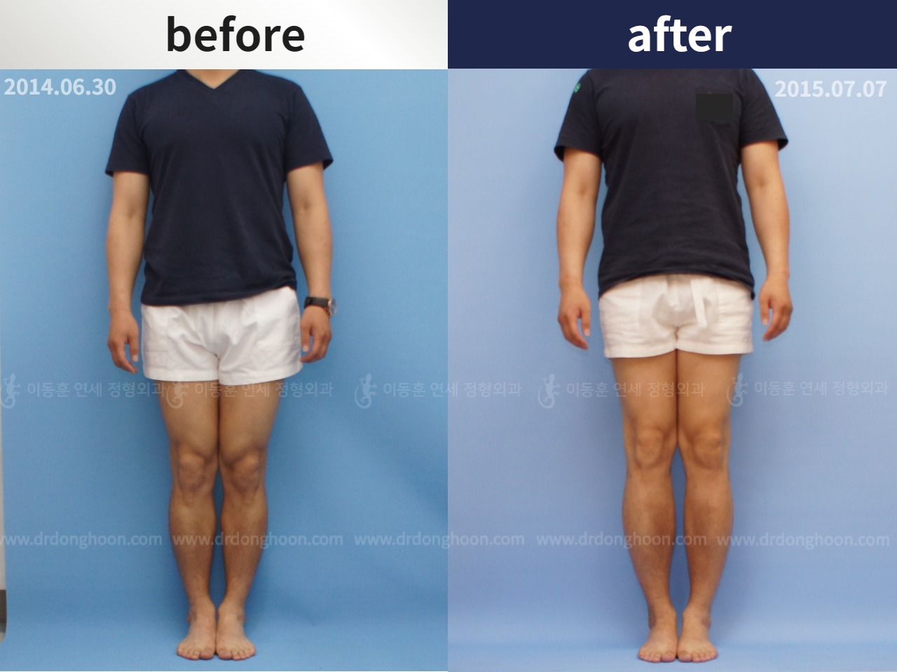 Before and after cll lon, case 4323961, image 2, Dr. Donghoon institute (DALRI)