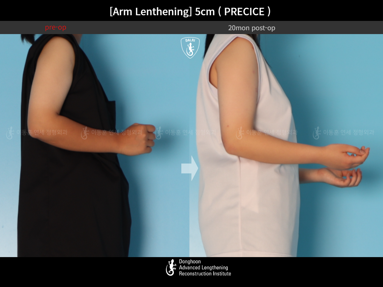 Before and after arm lengthening, case 18471704, image 5, Dr. Donghoon institute (DALRI)