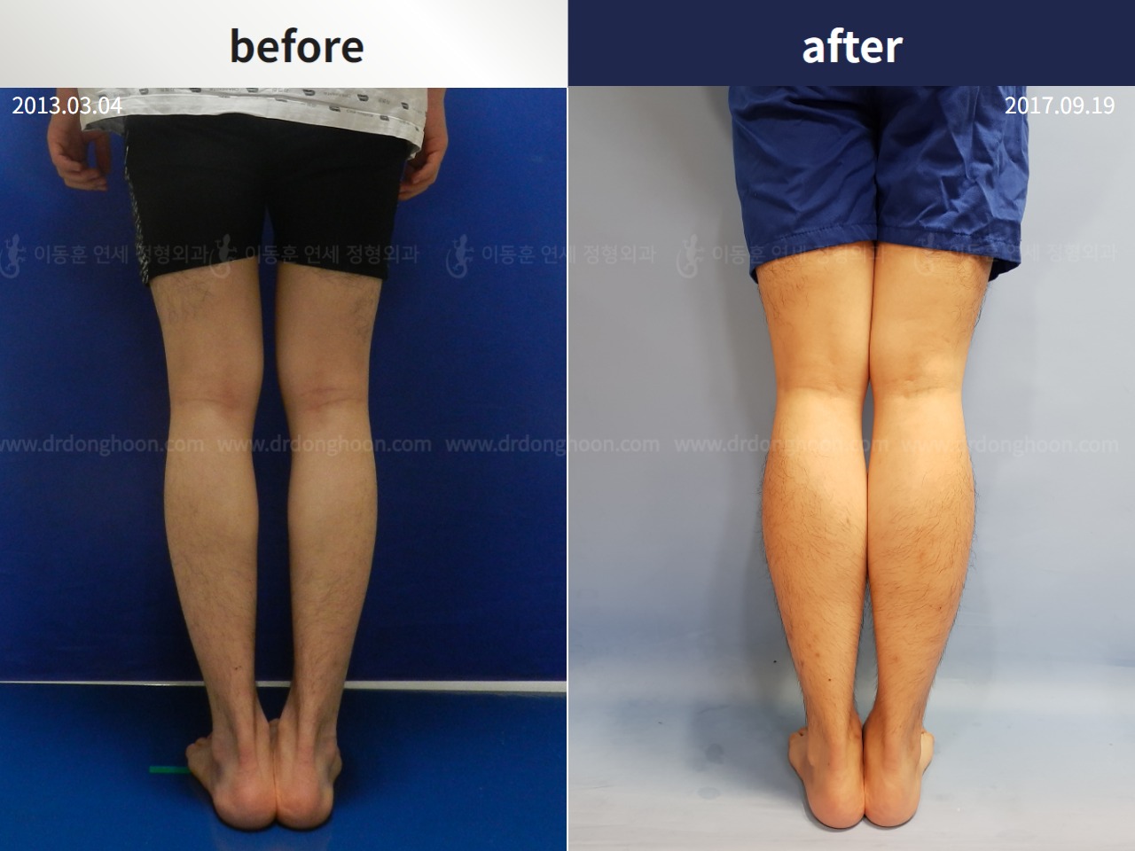 Before and after cll + deformity correction, case 4323099, image 2, Dr. Donghoon institute (DALRI)