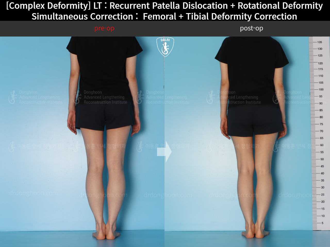 Before and after adult bowlegs, case 18088212, image 8, Dr. Donghoon institute (DALRI)
