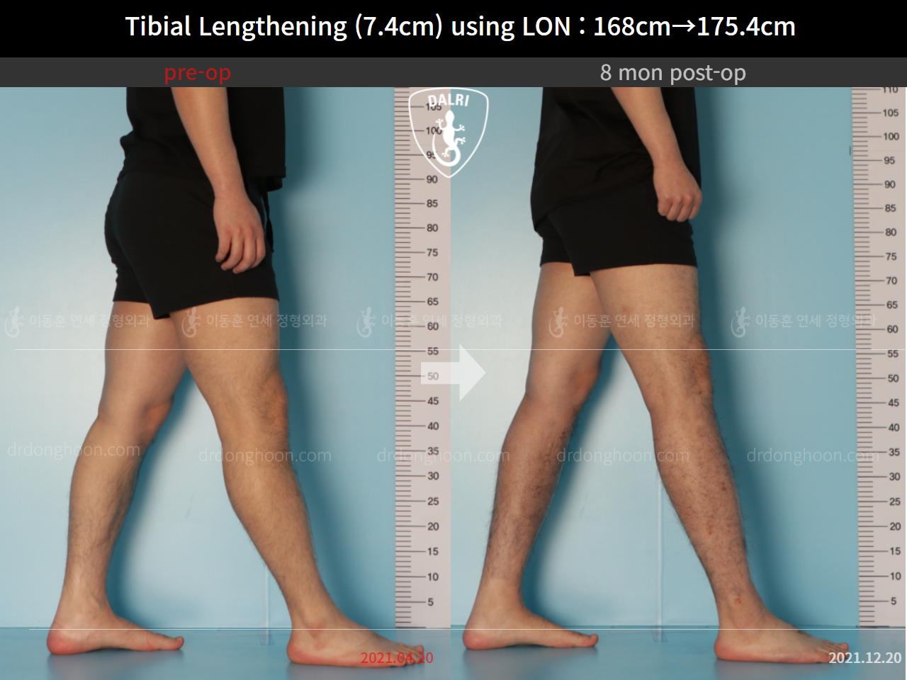 Before and after cll lon, case 9188051, image 7, Dr. Donghoon institute (DALRI)