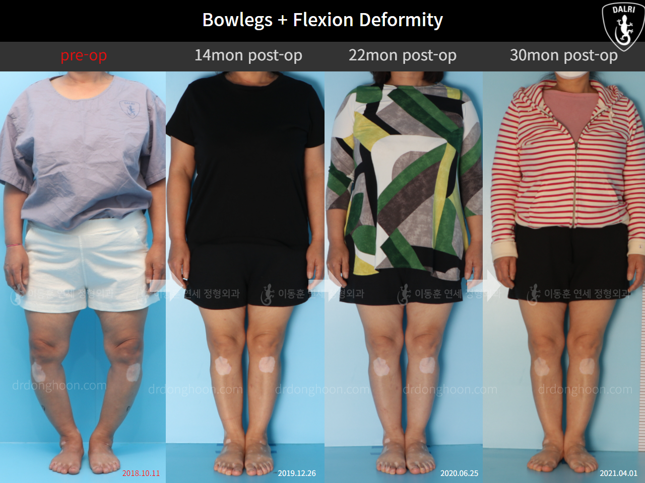 Before and after osteotomy for knee osteoarthritis, case 4586352, image 1, Dr. Donghoon institute (DALRI)