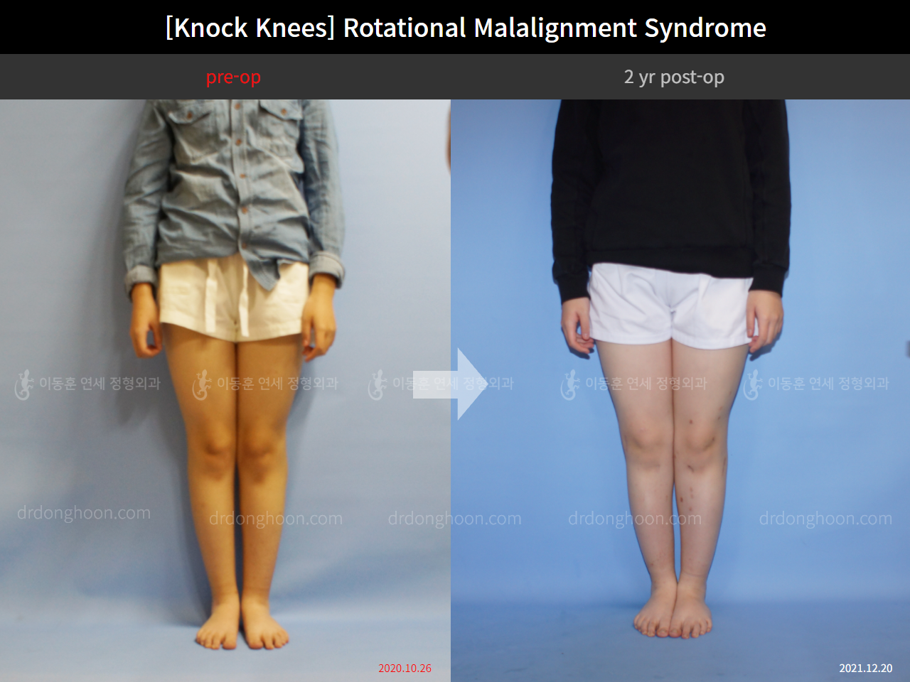 Before and after adult knock knees, case 9232717, image 4, Dr. Donghoon institute (DALRI)