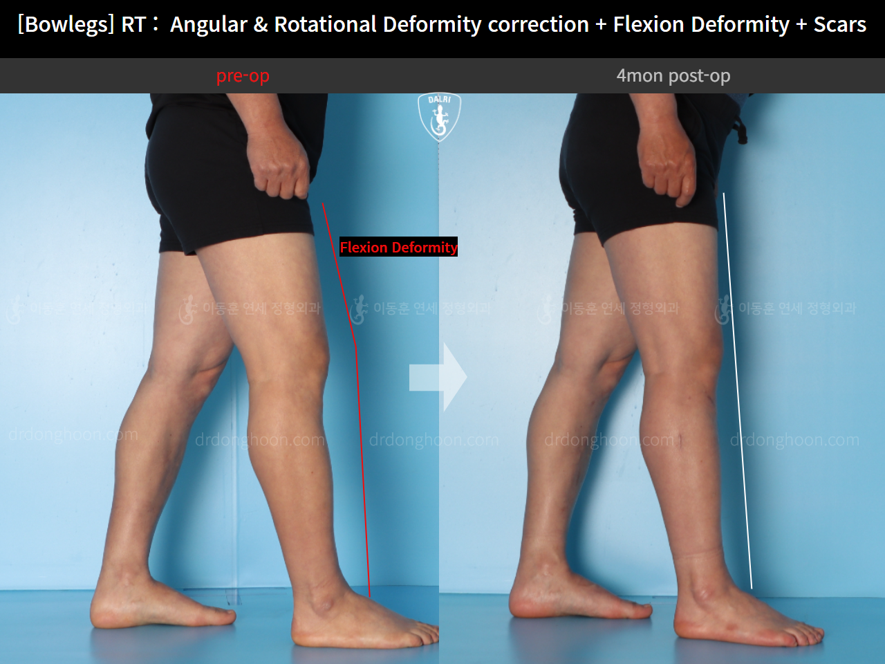 Before and after adult bowlegs, case 14701830, image 9, Dr. Donghoon institute (DALRI)