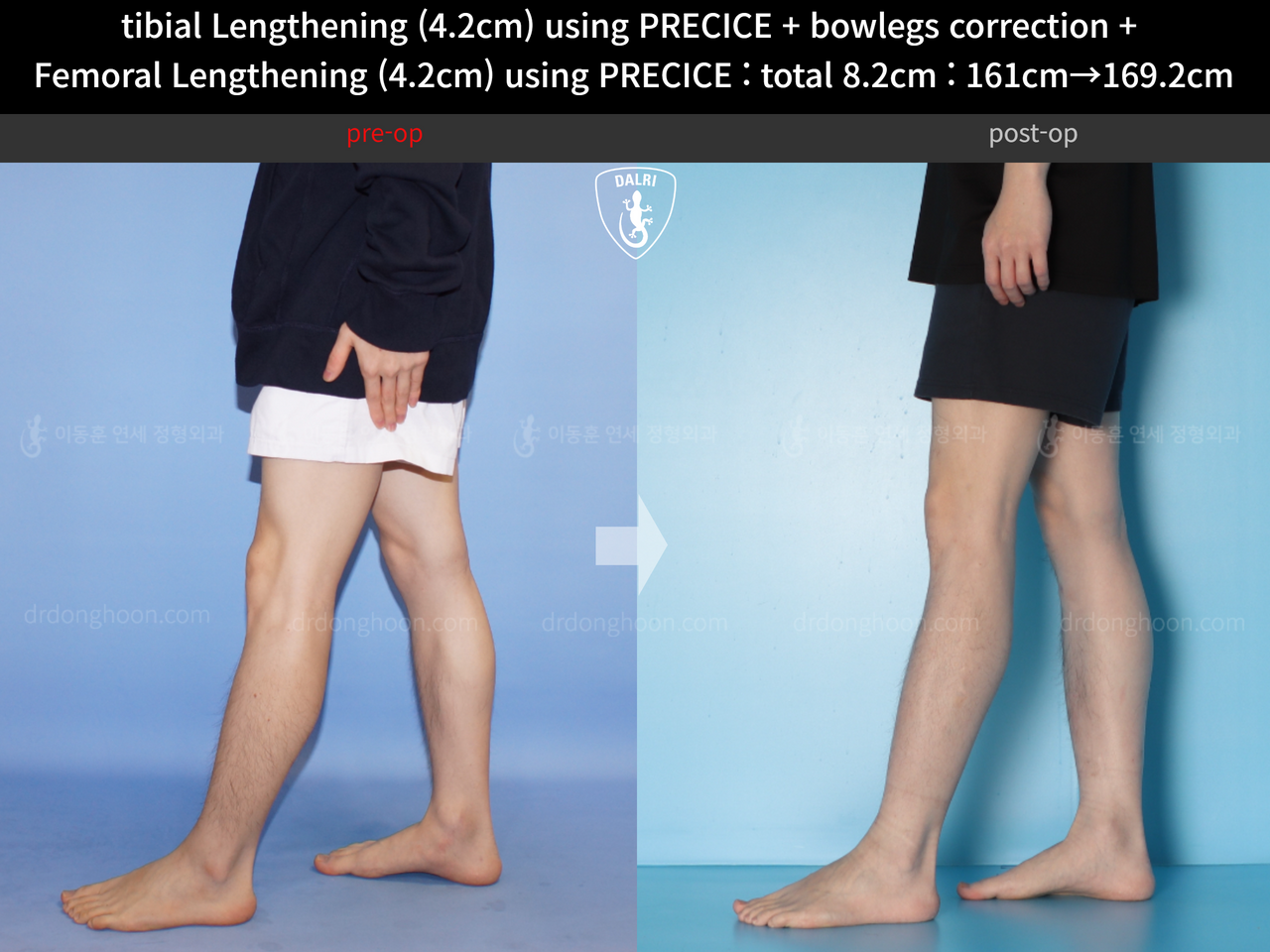 Before and after cll precice, case 14235714, image 8, Dr. Donghoon institute (DALRI)