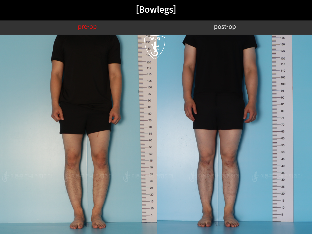 Before and after adult bowlegs, case 44111770, image 3, Dr. Donghoon institute (DALRI)
