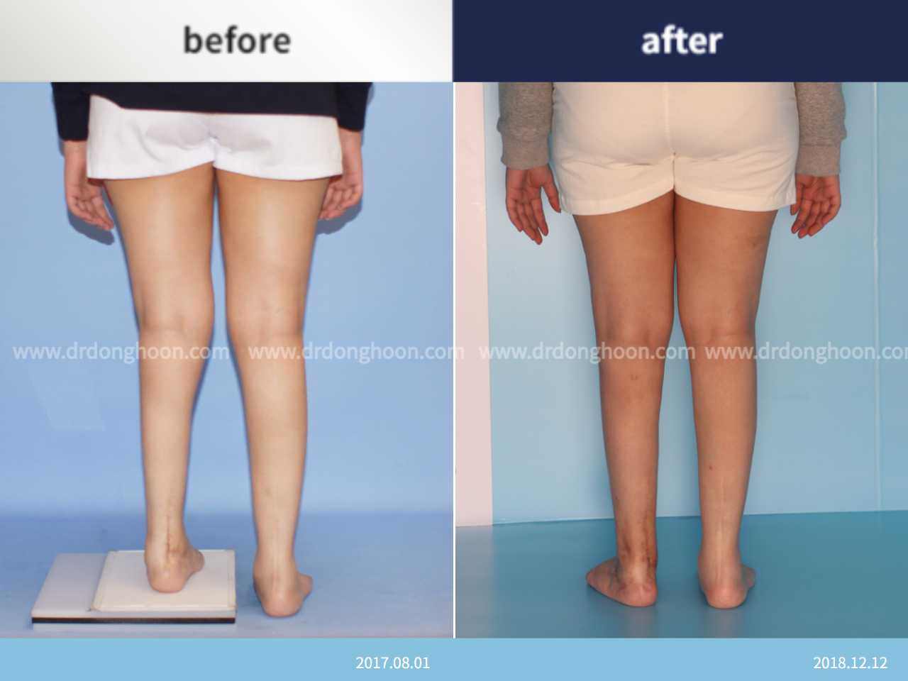 Before and after complex deformity, case 4795338, image 2, Dr. Donghoon institute (DALRI)