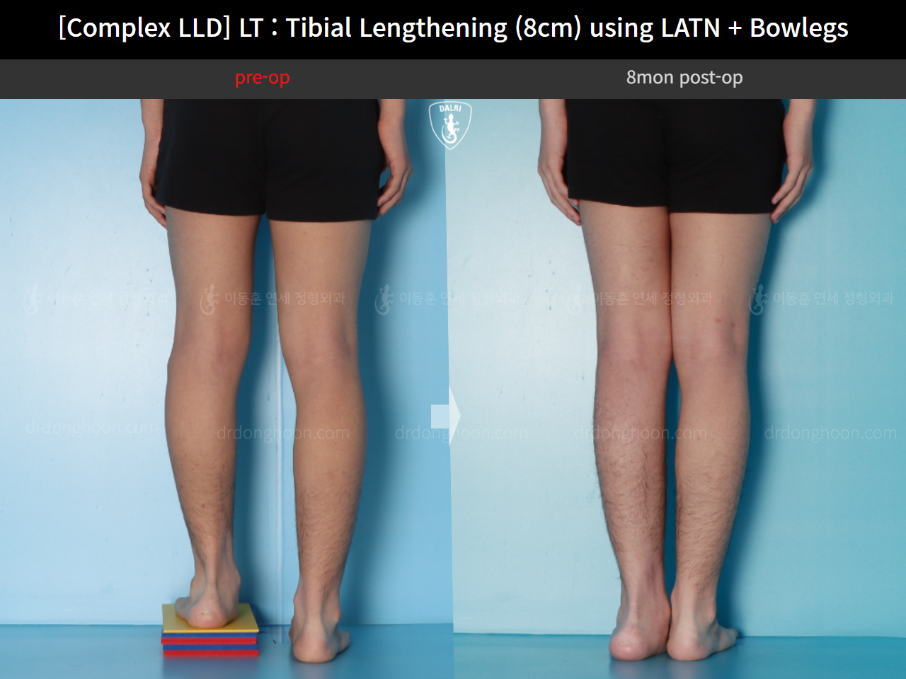 Before and after adult lld, case 16724300, image 6, Dr. Donghoon institute (DALRI)