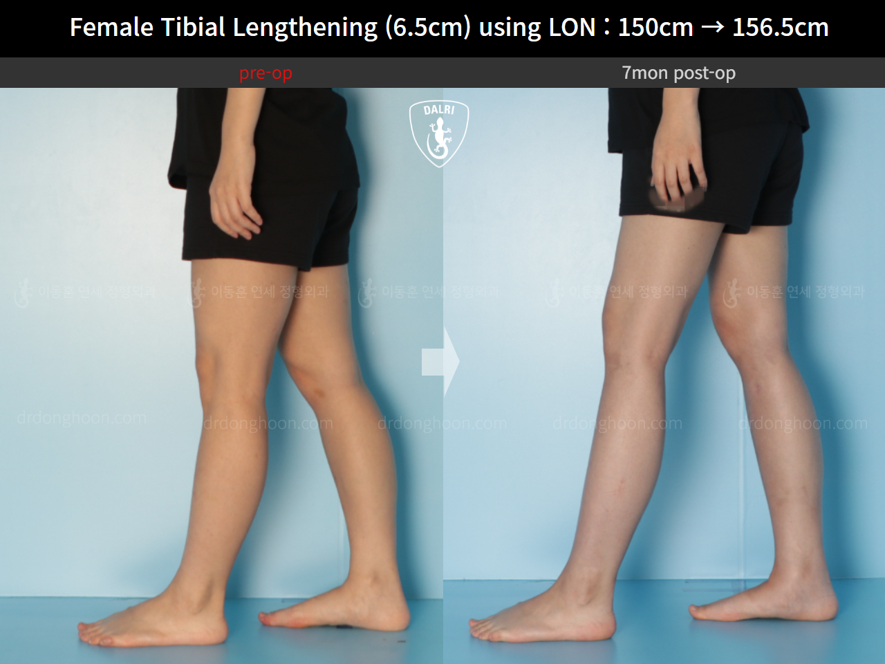 Before and after cll lon, case 16061220, image 7, Dr. Donghoon institute (DALRI)