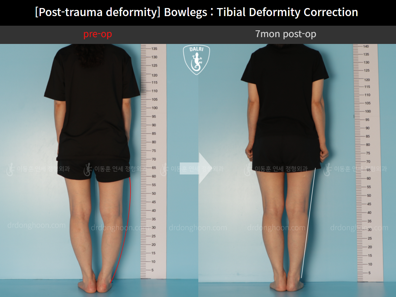 Before and after osteotomy for knee osteoarthritis, case 10389290, image 4, Dr. Donghoon institute (DALRI)