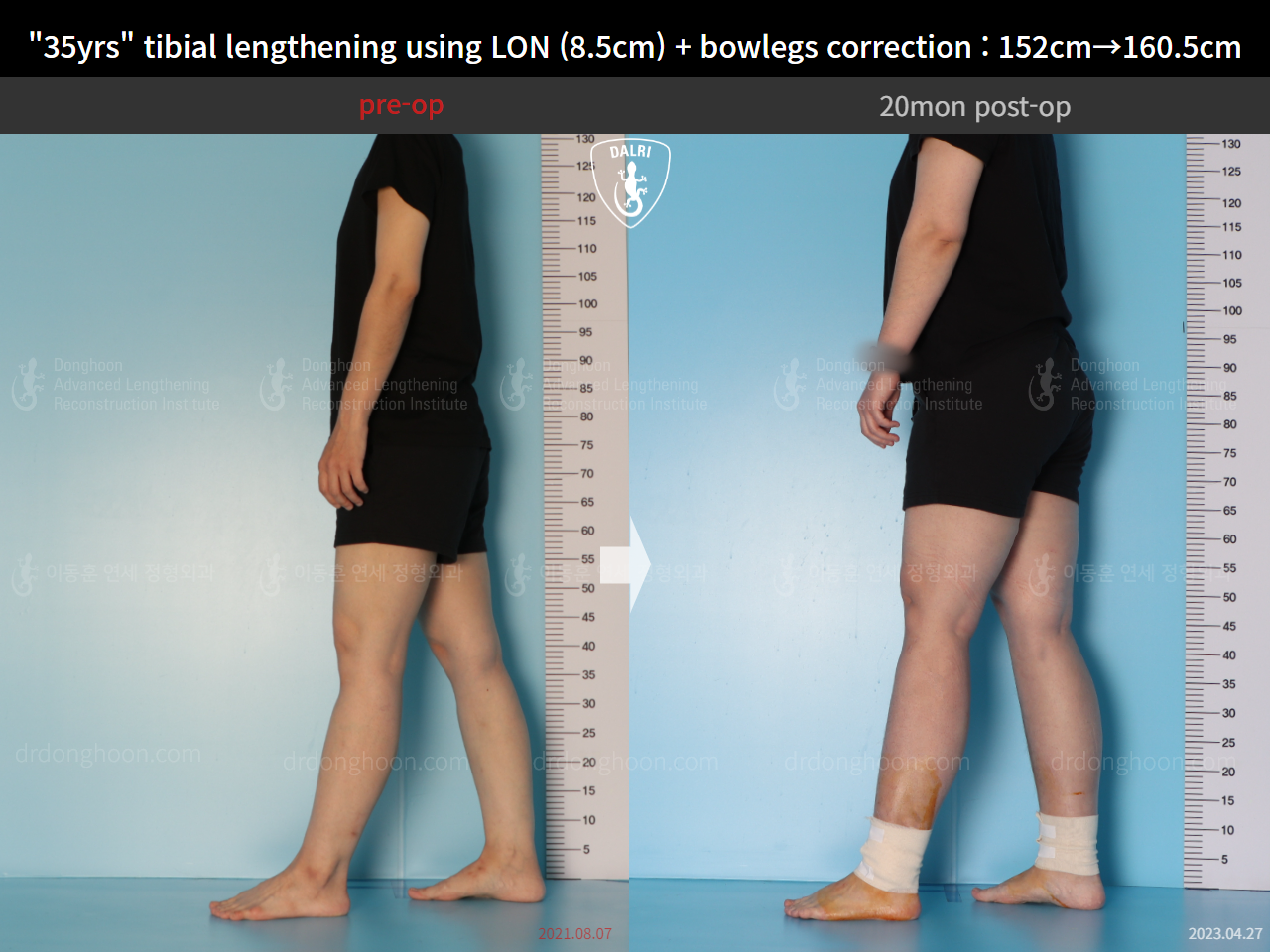 Before and after cll lon, case 15036651, image 4, Dr. Donghoon institute (DALRI)