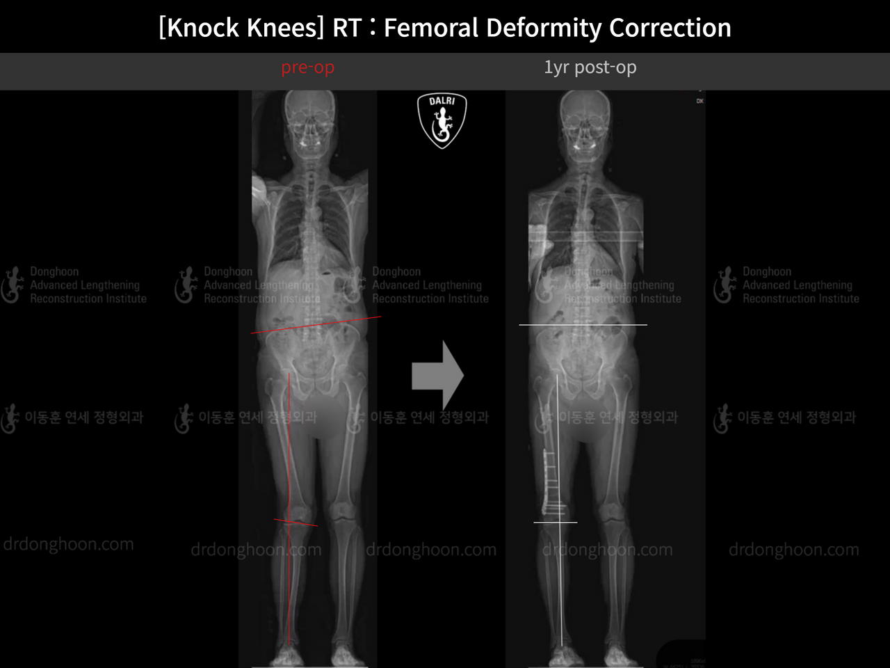 Before and after adult knock knees, case 14236357, image 10, Dr. Donghoon institute (DALRI)