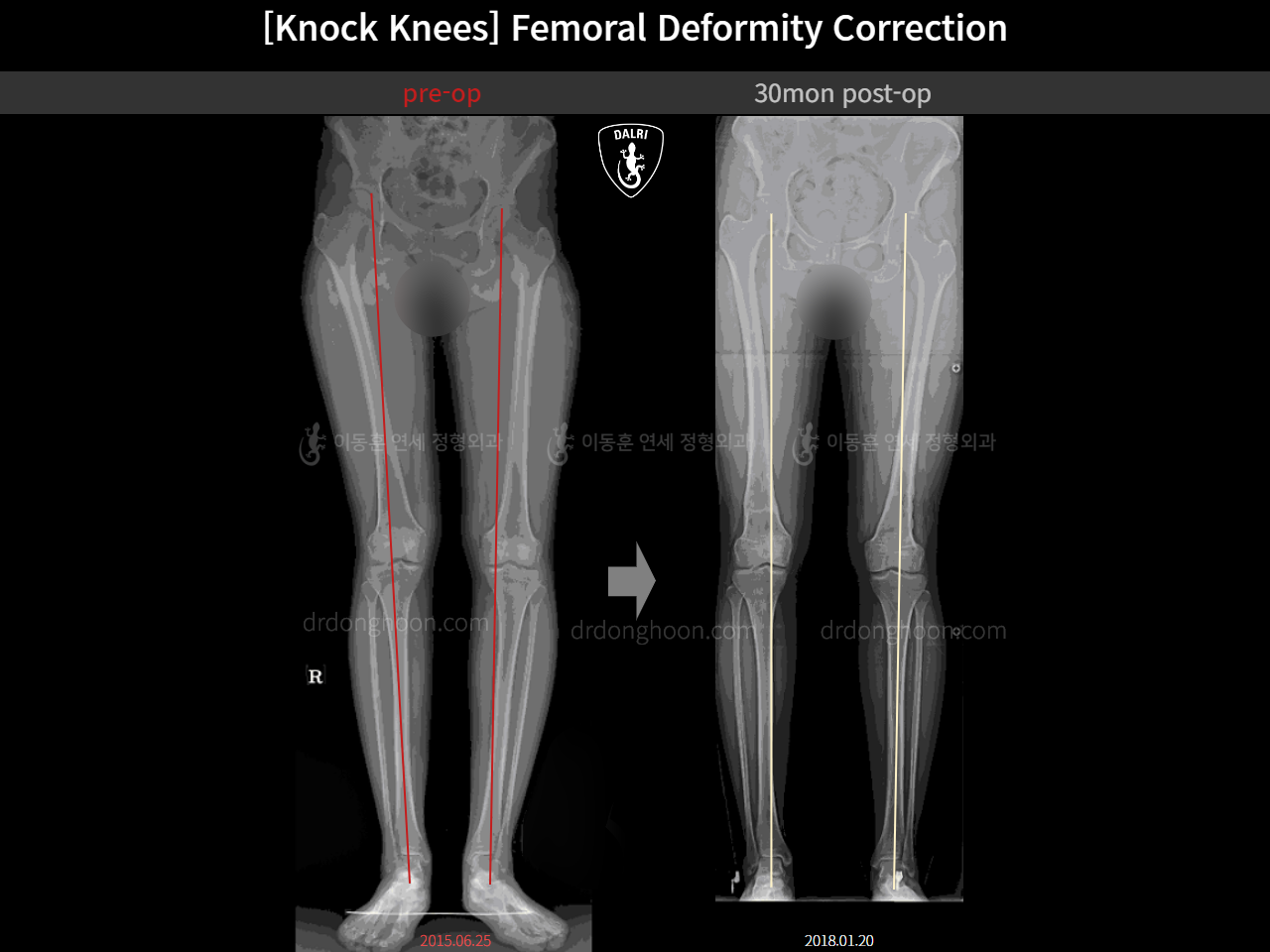 Before and after adult knock knees, case 15674660, image 2, Dr. Donghoon institute (DALRI)