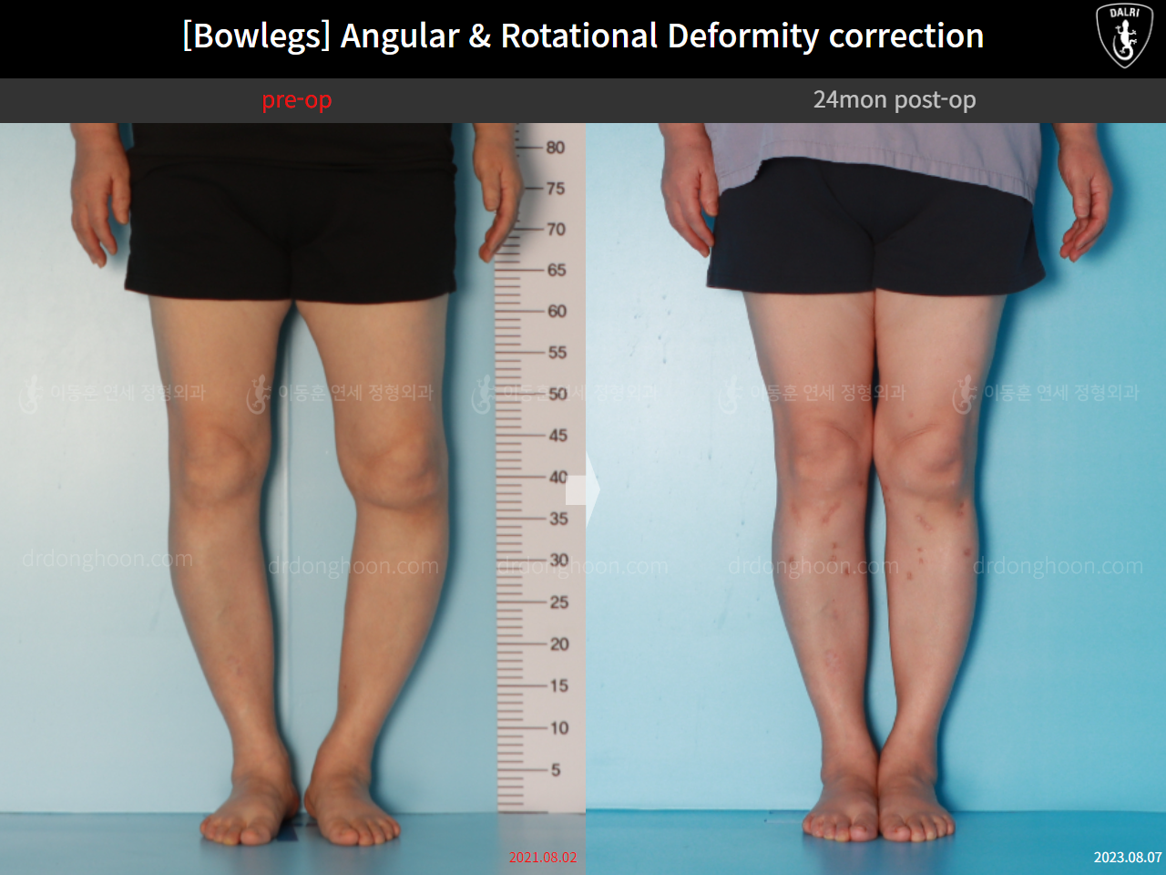 Before and after adult bowlegs, case 16074478, image 5, Dr. Donghoon institute (DALRI)