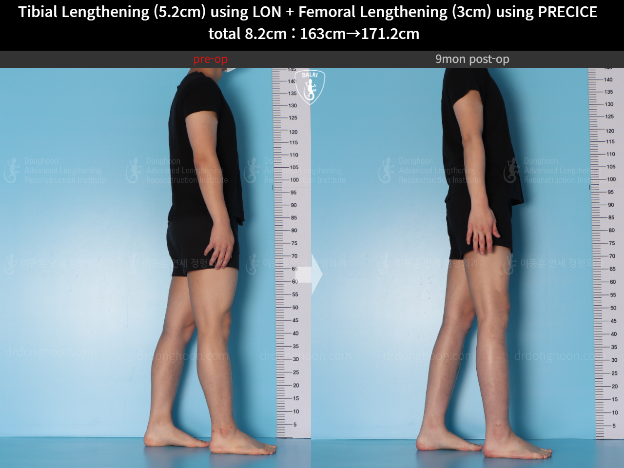 Before and after cll lon, case 15203339, image 6, Dr. Donghoon institute (DALRI)