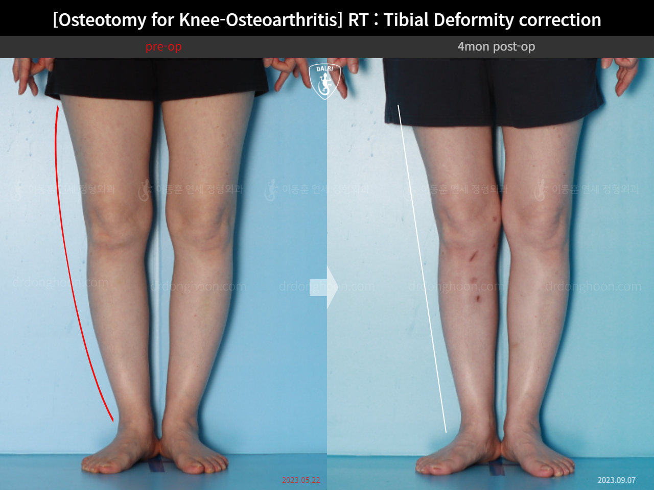 Before and after osteotomy for knee osteoarthritis, case 17890677, image 7, Dr. Donghoon institute (DALRI)
