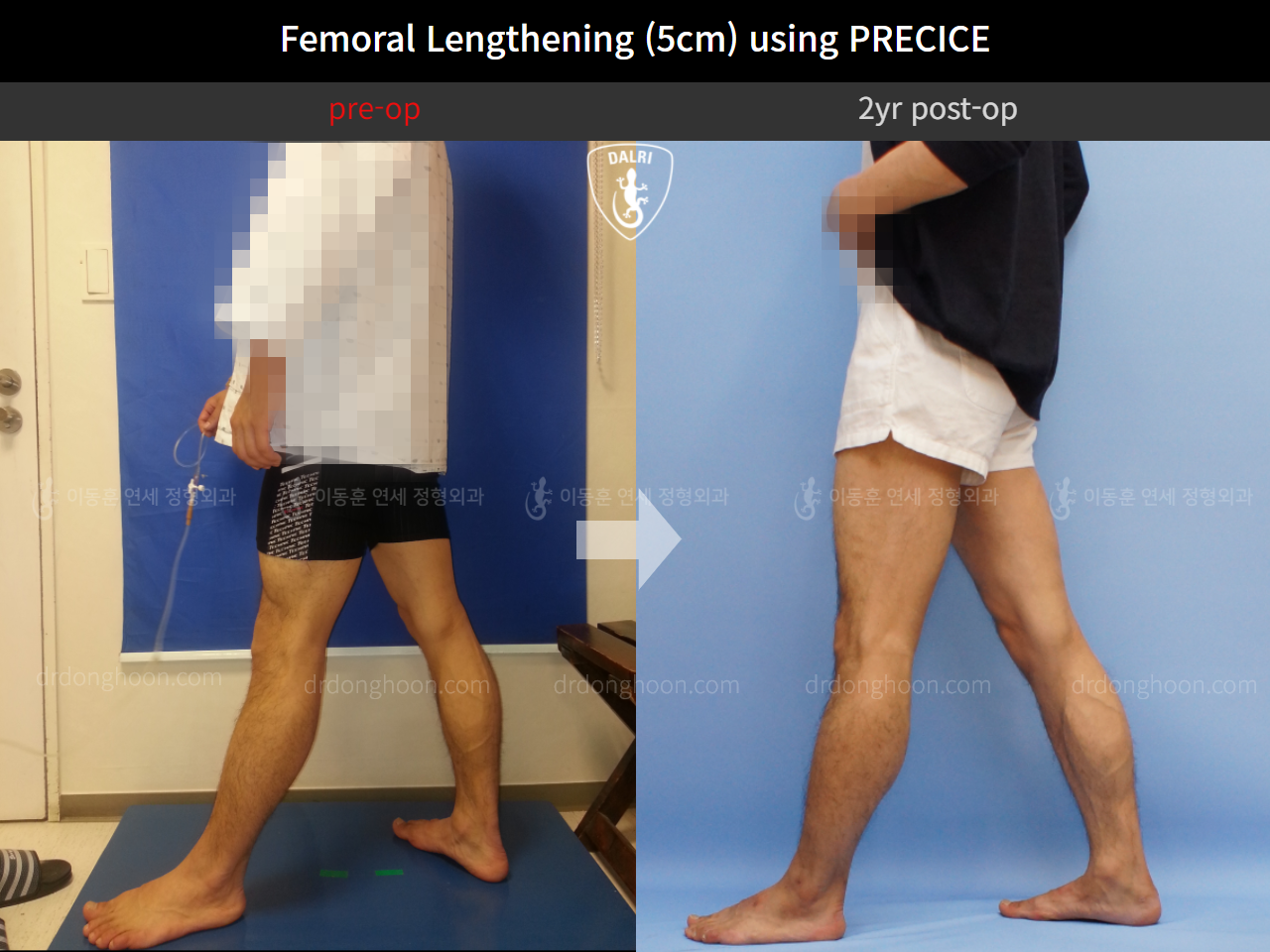 Before and after cll precice, case 4323372, image 3, Dr. Donghoon institute (DALRI)