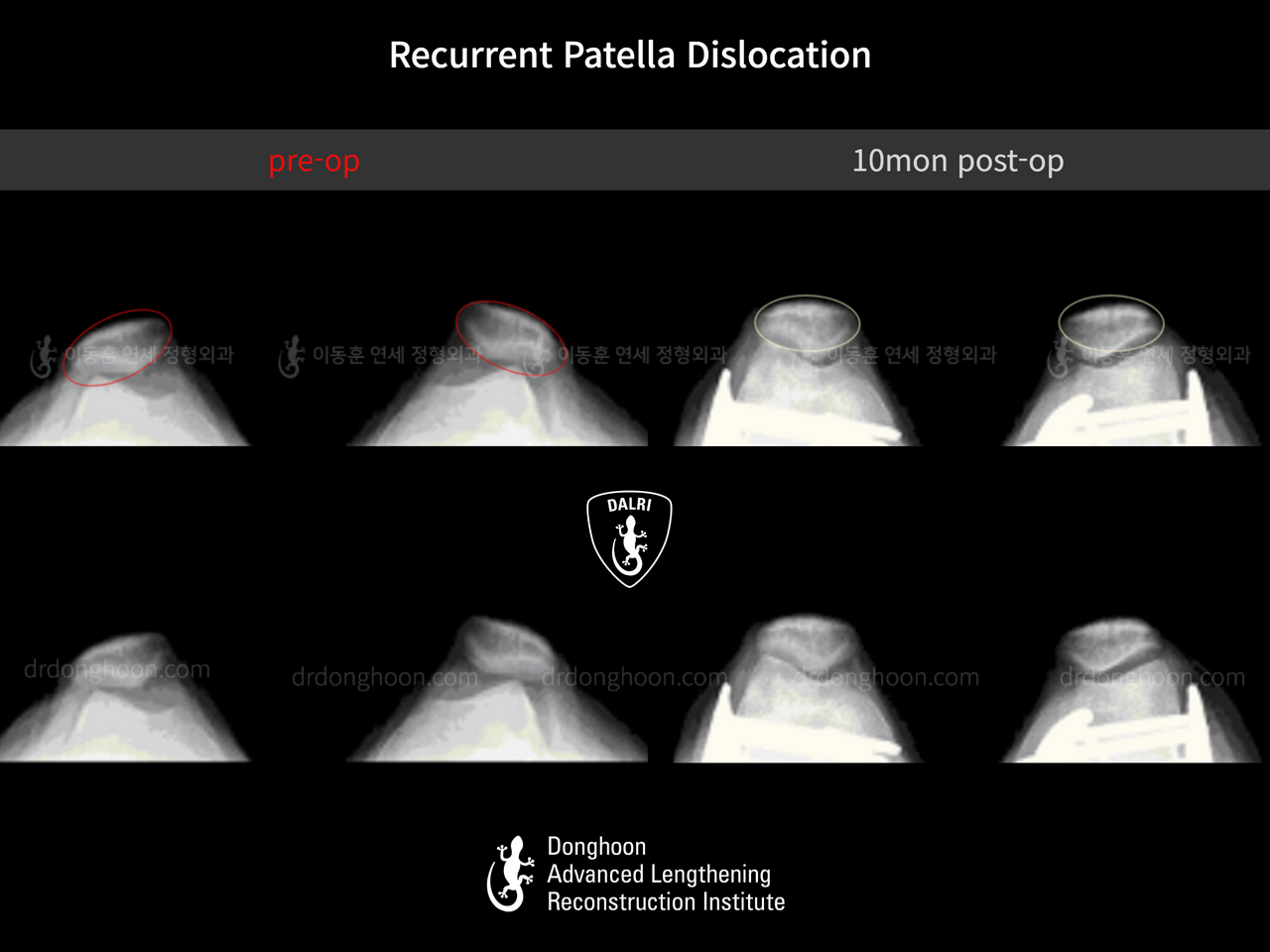 Before and after recurrent patella dislocation, case 12860909, image 1, Dr. Donghoon institute (DALRI)
