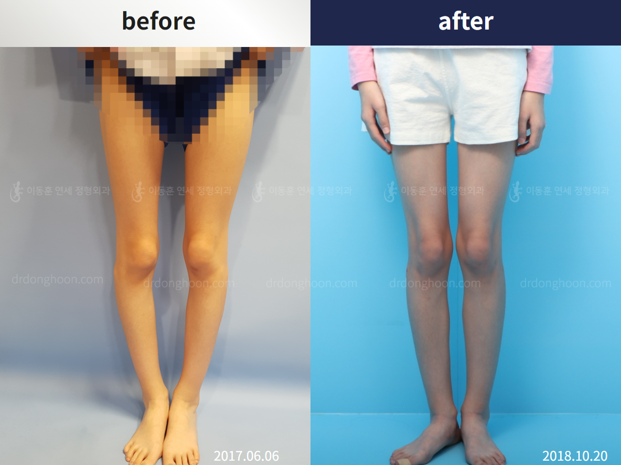 Before and after paediatric & adolescent bowlegs, case 4320267, image 1, Dr. Donghoon institute (DALRI)