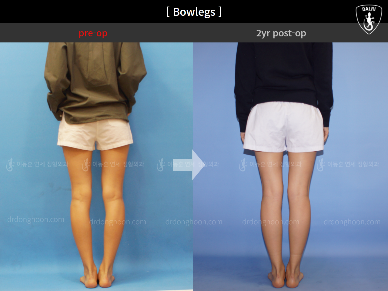 Before and after adult bowlegs, case 4311371, image 4, Dr. Donghoon institute (DALRI)