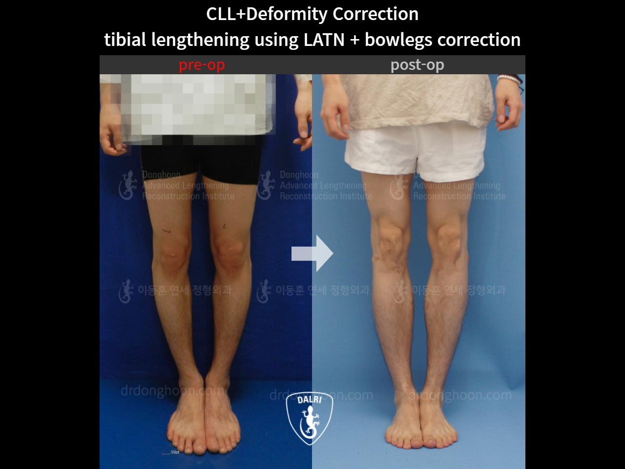 Before and after cll + deformity correction, case 4567585, image 4, Dr. Donghoon institute (DALRI)