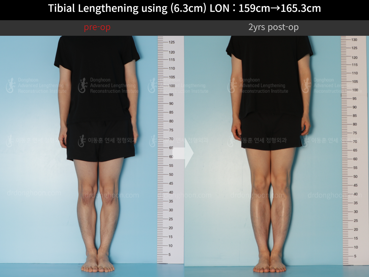 Before and after cll lon, case 12096536, image 3, Dr. Donghoon institute (DALRI)