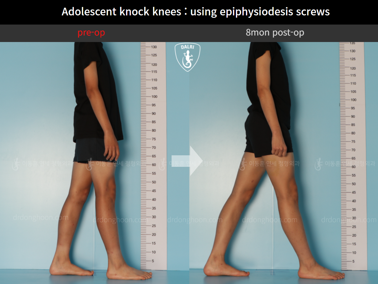 Before and after paediatric & adolescent knock knees, case 10171145, image 5, Dr. Donghoon institute (DALRI)