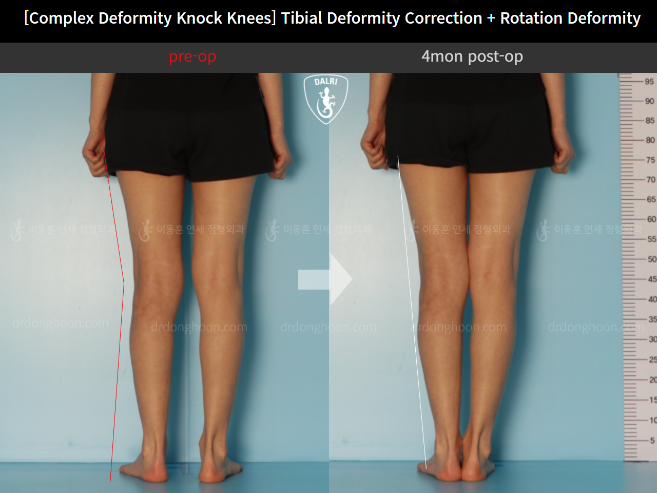 Before and after adult knock knees, case 11747832, image 4, Dr. Donghoon institute (DALRI)