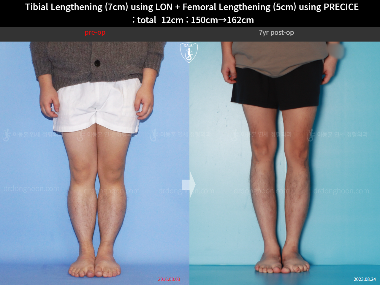 Before and after cll precice, case 16146445, image 9, Dr. Donghoon institute (DALRI)