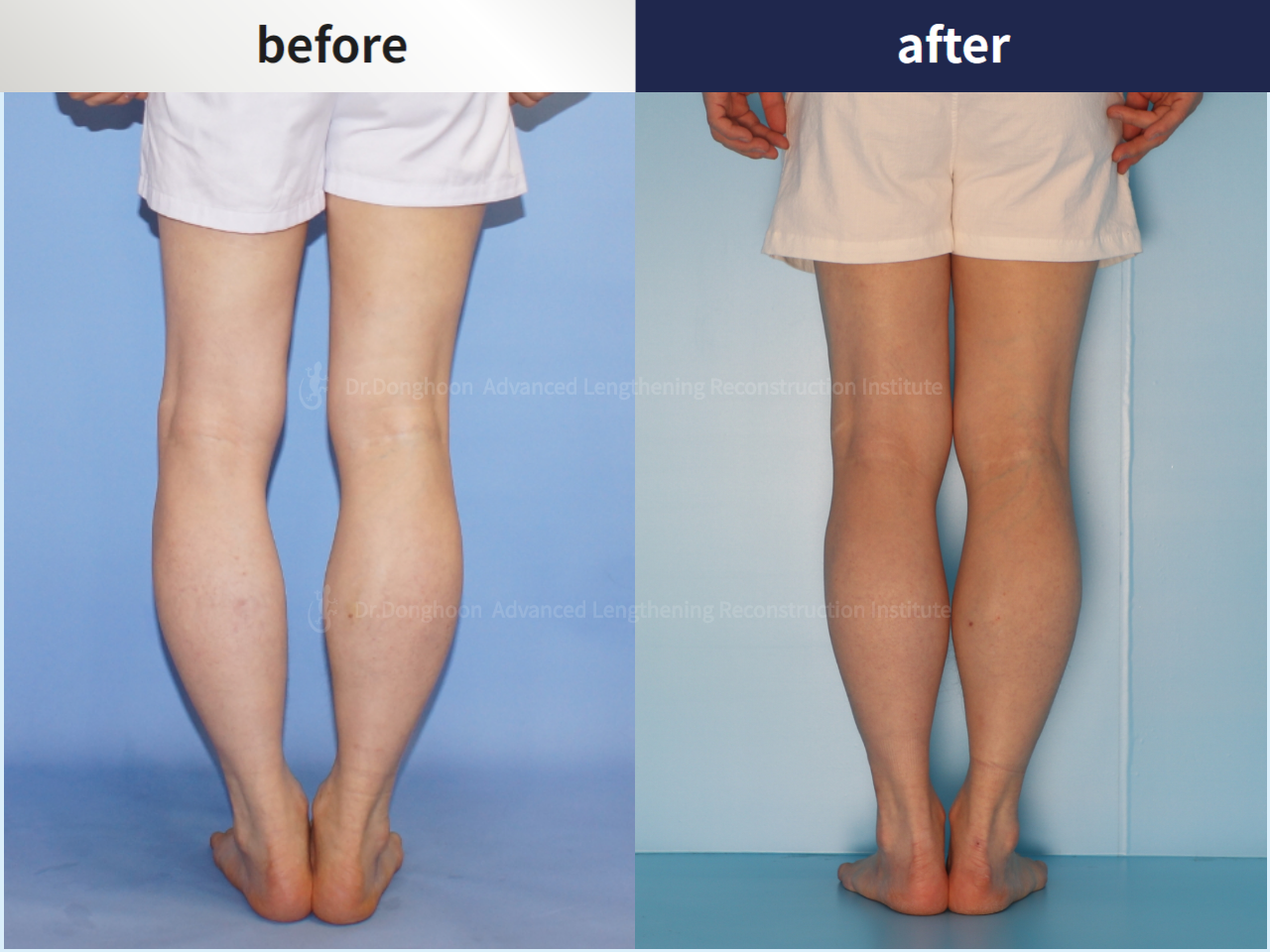 Before and after osteotomy for knee osteoarthritis, case 4306432, image 1, Dr. Donghoon institute (DALRI)