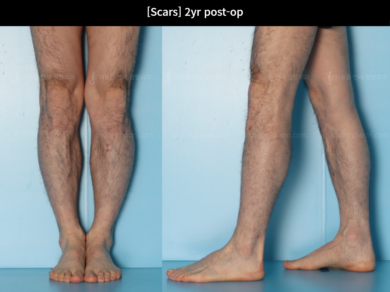 Before and after adult bowlegs, case 16933272, image 8, Dr. Donghoon institute (DALRI)
