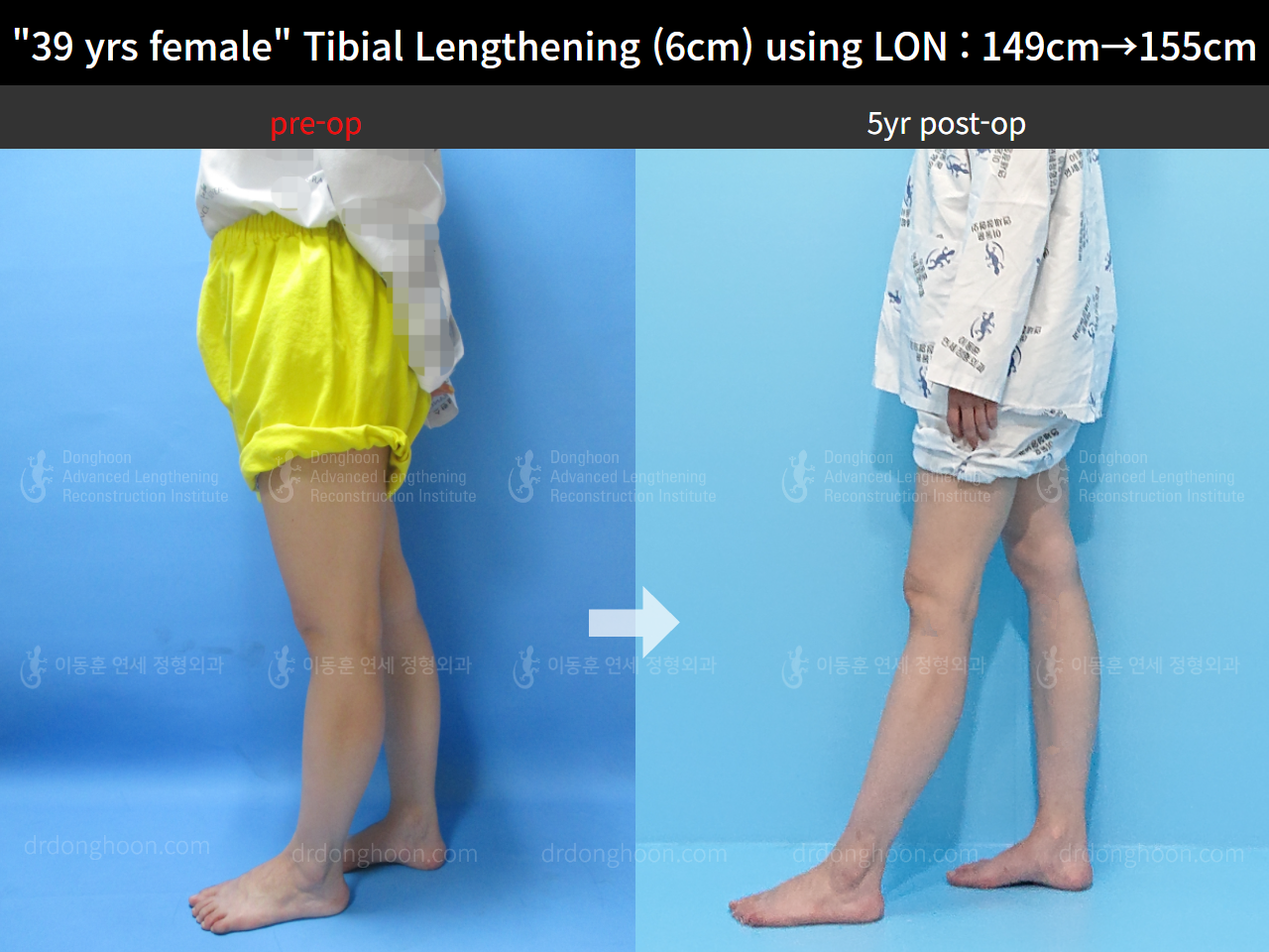Before and after cll lon, case 8626950, image 4, Dr. Donghoon institute (DALRI)