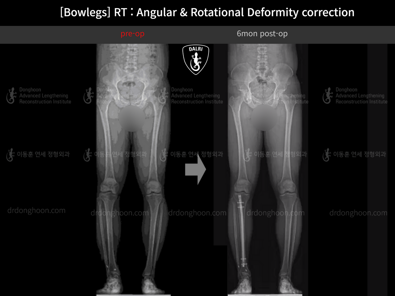 Before and after adult bowlegs, case 13664056, image 5, Dr. Donghoon institute (DALRI)