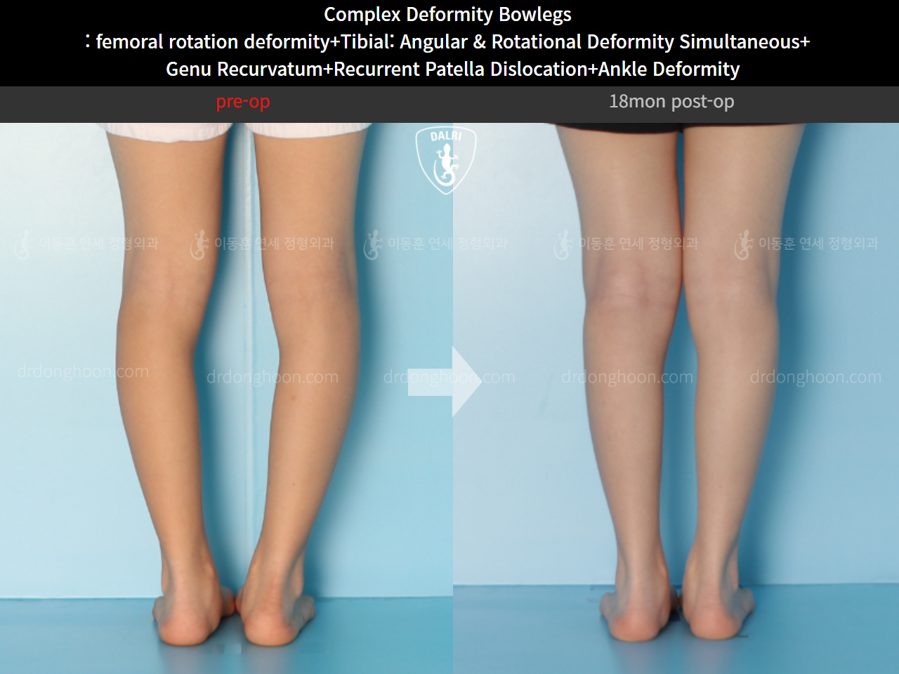 Before and after adult bowlegs, case 11243996, image 5, Dr. Donghoon institute (DALRI)
