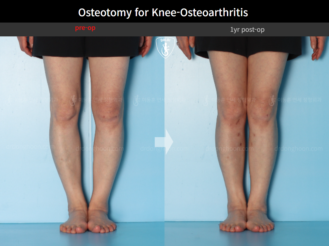 Before and after osteotomy for knee osteoarthritis, case 16893966, image 6, Dr. Donghoon institute (DALRI)
