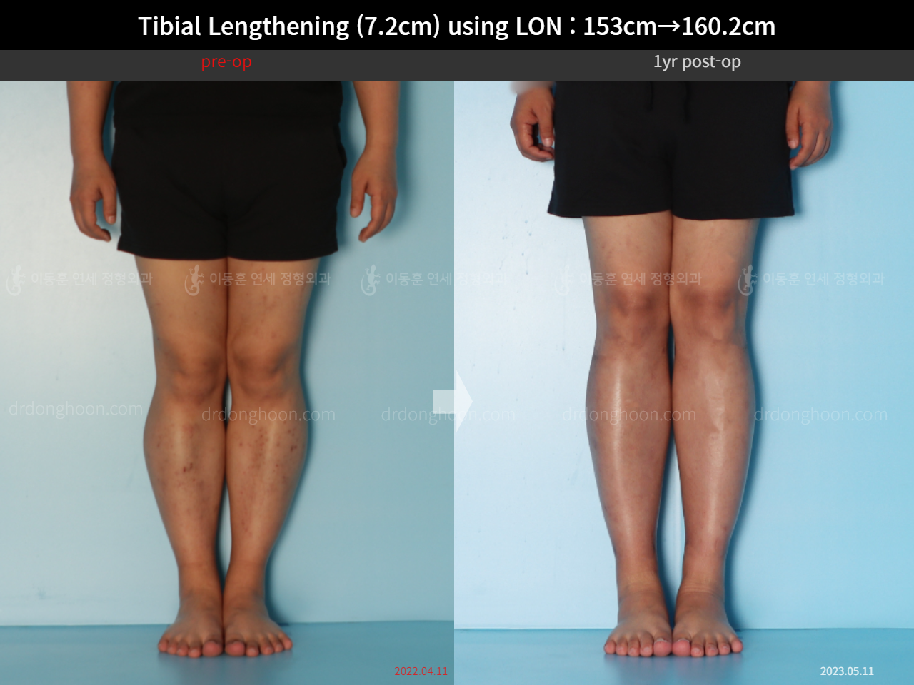 Before and after cll lon, case 15150707, image 5, Dr. Donghoon institute (DALRI)